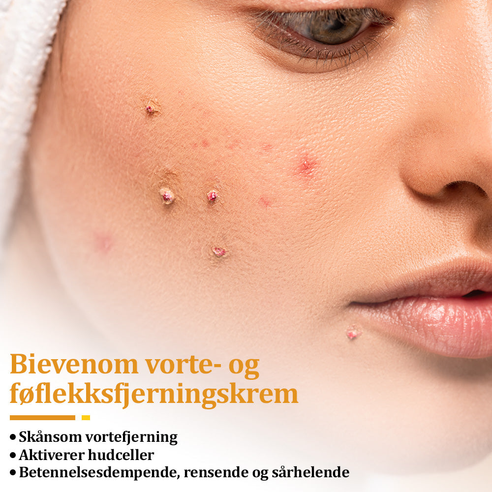 🐝flysmus™ Bievenom vorte- og føflekkfjerningskrem, sertifisert av Statens legemiddelverk (NoMA)💖✅