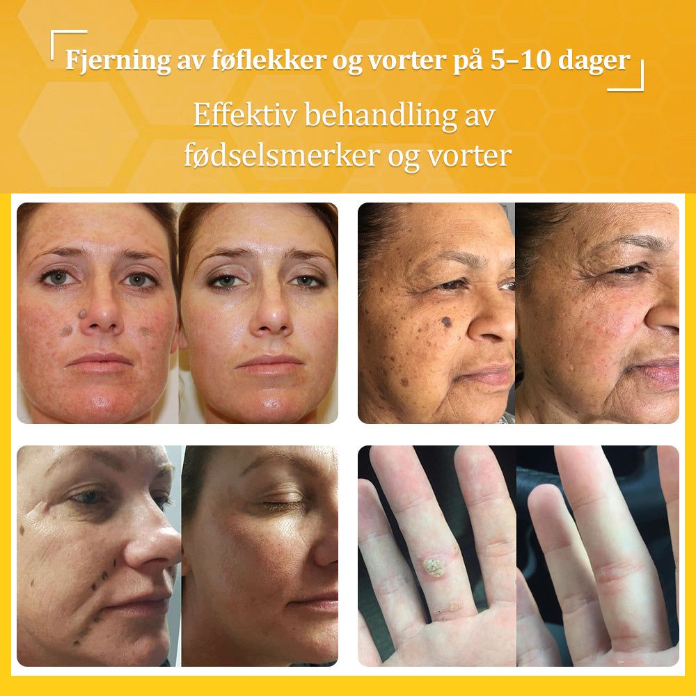 🐝flysmus™ Bievenom vorte- og føflekkfjerningskrem, sertifisert av Statens legemiddelverk (NoMA)💖✅