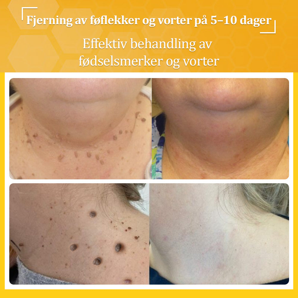 🐝flysmus™ Bievenom vorte- og føflekkfjerningskrem, sertifisert av Statens legemiddelverk (NoMA)💖✅