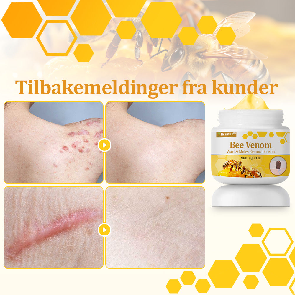 🐝flysmus™ Bievenom vorte- og føflekkfjerningskrem, sertifisert av Statens legemiddelverk (NoMA)💖✅