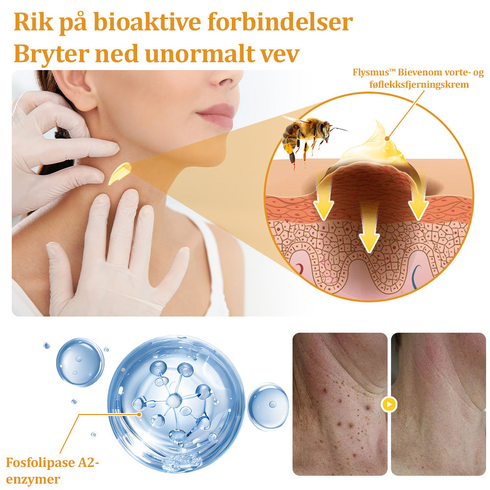 🐝flysmus™ Bievenom vorte- og føflekkfjerningskrem, sertifisert av Statens legemiddelverk (NoMA)💖✅