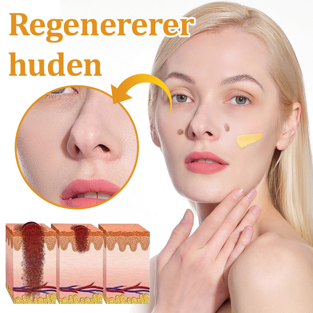 🐝flysmus™ Bievenom vorte- og føflekkfjerningskrem, sertifisert av Statens legemiddelverk (NoMA)💖✅