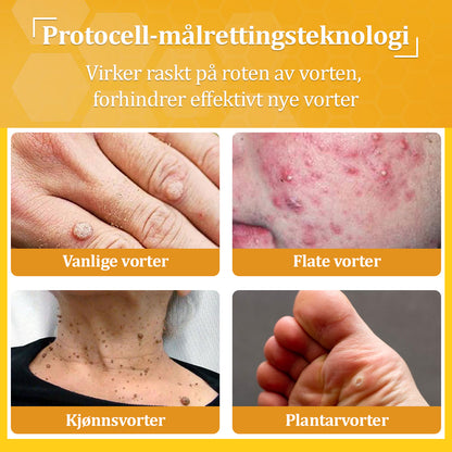 🐝flysmus™ Bievenom vorte- og føflekkfjerningskrem, sertifisert av Statens legemiddelverk (NoMA)💖✅