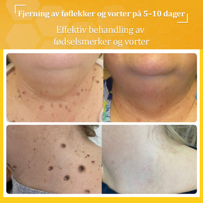 🐝flysmus™ Bievenom vorte- og føflekkfjerningskrem, sertifisert av Statens legemiddelverk (NoMA)💖✅