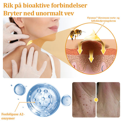 🐝flysmus™ Bievenom vorte- og føflekkfjerningskrem, sertifisert av Statens legemiddelverk (NoMA)💖✅